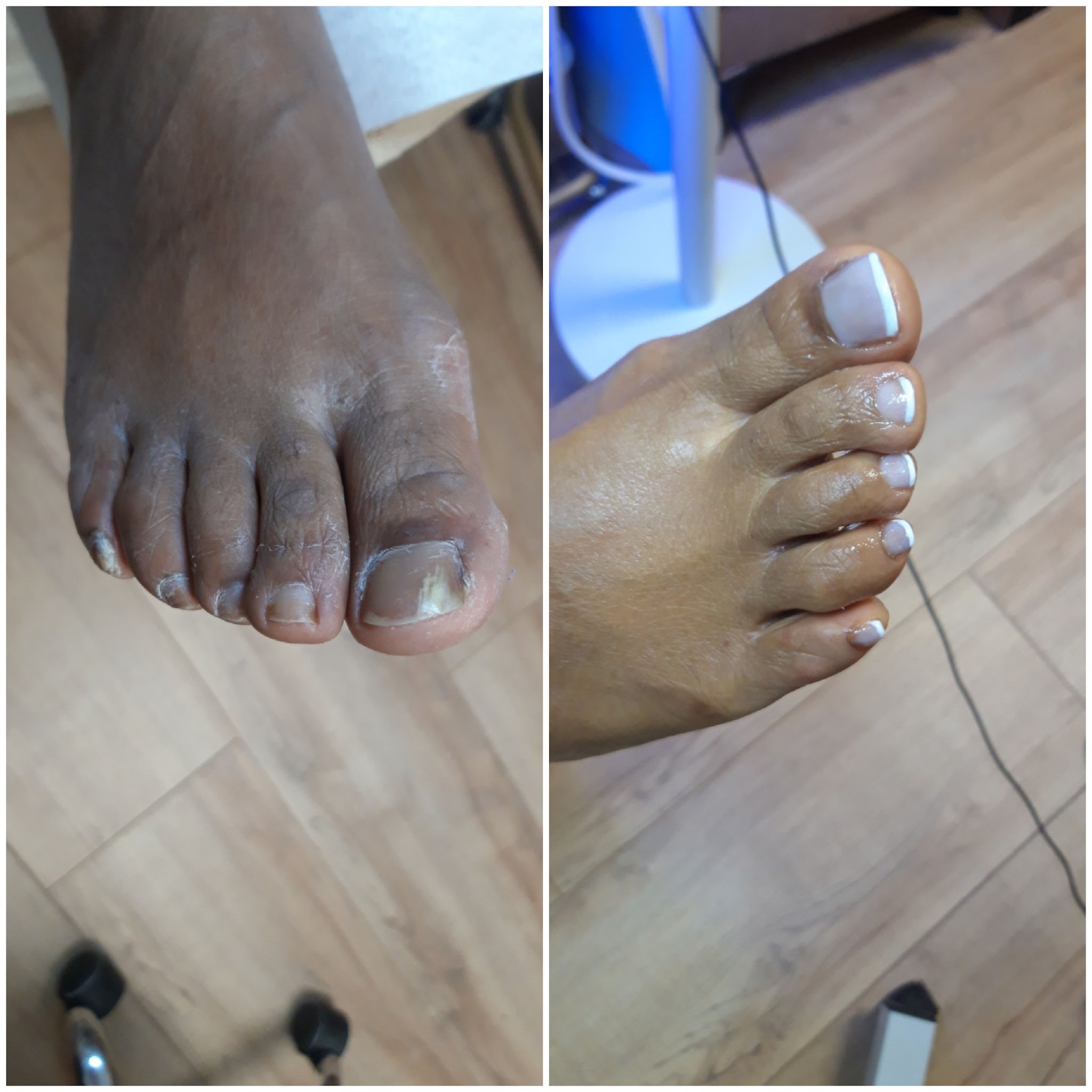 Voor en na een pedicure: links verdikte teennagels, rechts verzorgd met French
